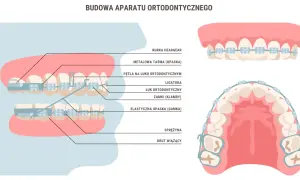 Schemat budowy aparatu ortodontycznego: zamki, łuk, ligatury, sprężyna i drut wiążący na zębach.