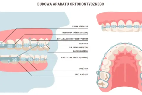 Schemat budowy aparatu ortodontycznego: zamki, łuk, ligatury, sprężyna i drut wiążący na zębach.