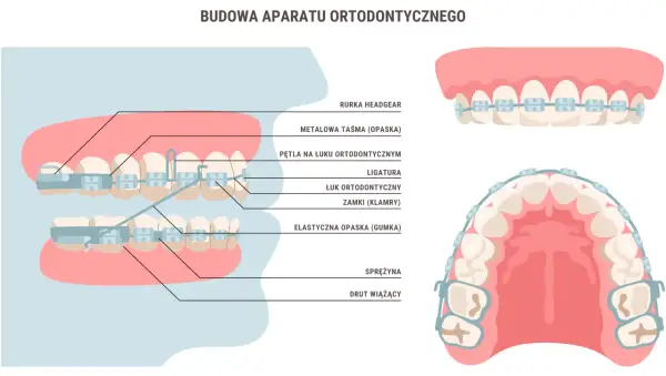 Schemat budowy aparatu ortodontycznego: zamki, łuk, ligatury, sprężyna i drut wiążący na zębach.